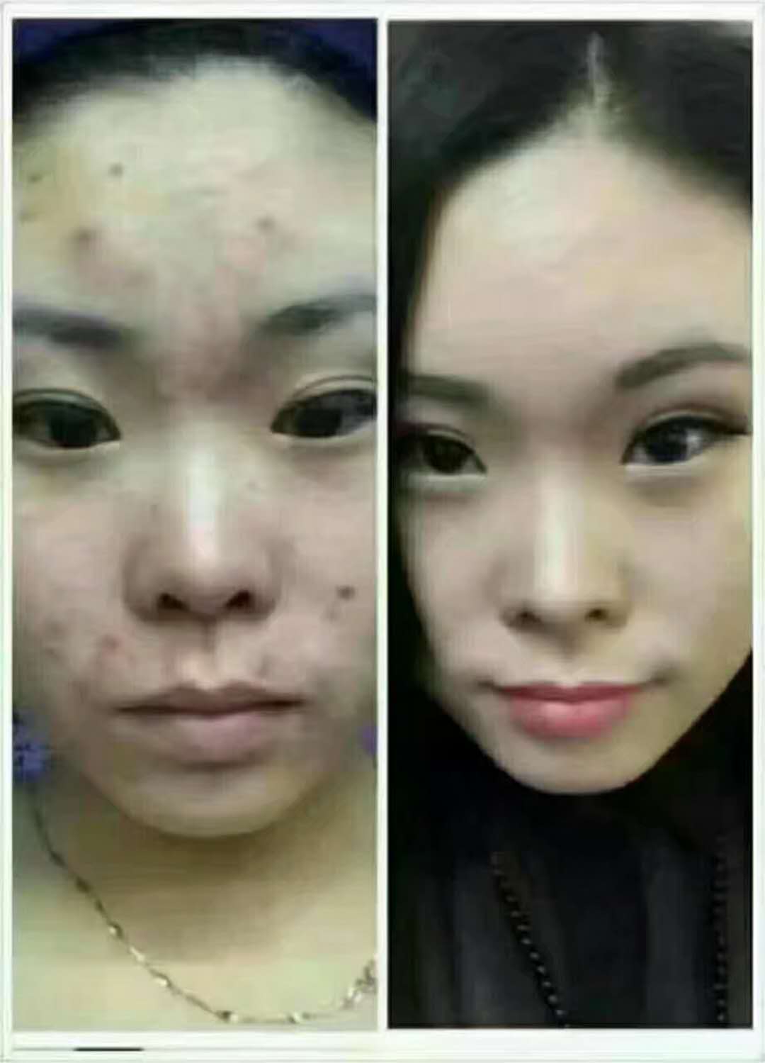 有痘烦恼?咋样才能打败痘痘